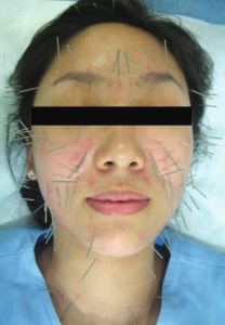 agopuntura, estetica, bellezza, viso, filling