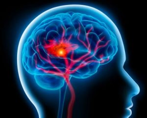 Ictus cerebrale ischemico