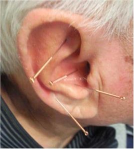 agopuntura auricolare ansia e umore