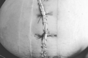 agopuntura, ileo paralitico, flatulenza